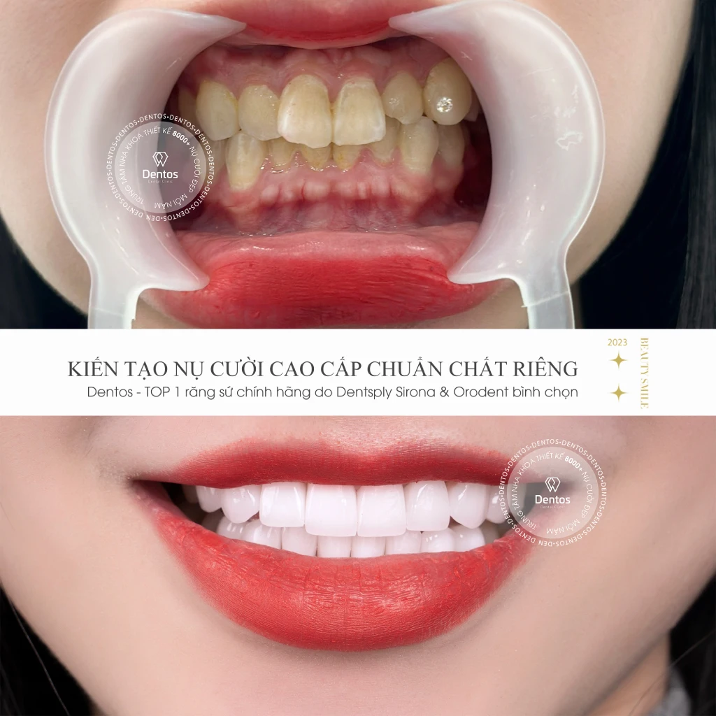 Răng khấp khểnh nhẹ có thể bọc sứ để cải thiện thẩm mỹ